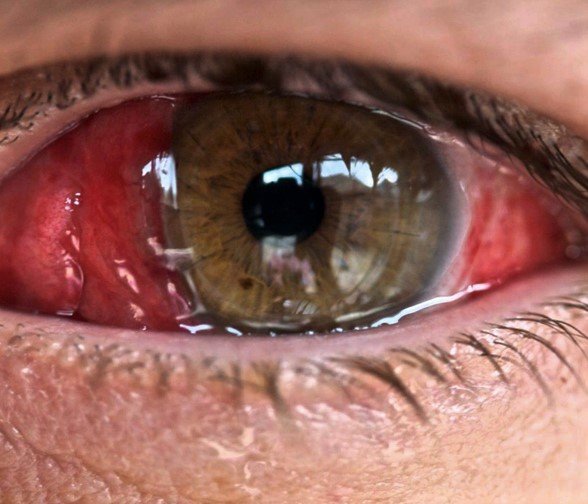 Перша допомога при хімічних опіках очей: як захистити зір?