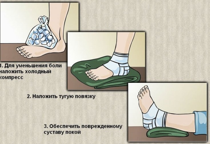 Як надати першу допомогу при розтягненні зв’язок: практичні поради