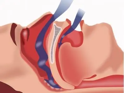 Як діяти: перша допомога при зупинці дихання – покрокова інструкція