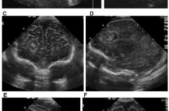 Набряк головного мозку у новонароджених: наслідки та ризики здоров’я