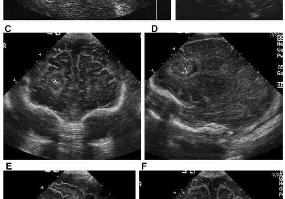 Набряк головного мозку у новонароджених: наслідки та ризики здоров’я