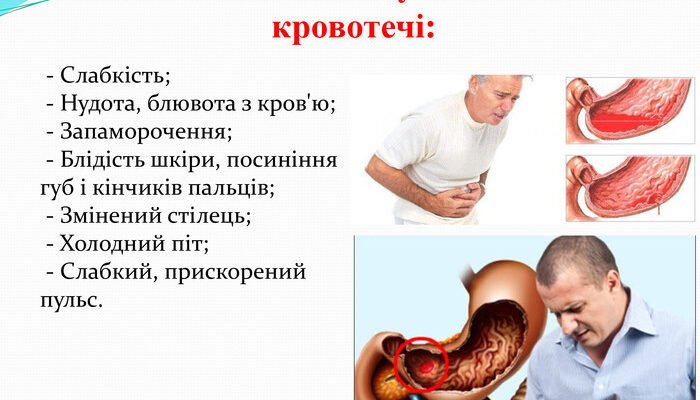 Шлунково-кишкова кровотеча: ефективна перша допомога і поради