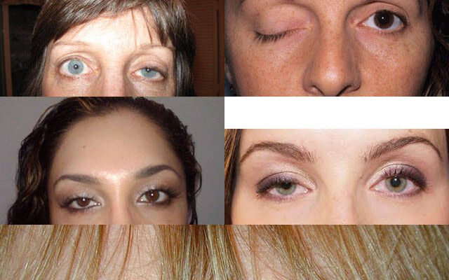 Негативні наслідки ботоксу: що варто знати перед процедурою