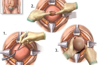Чи можна робити кесарів розтин за бажанням: переваги та ризики