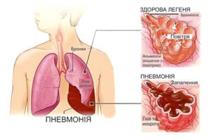 Чи можна вилікувати запалення легень без антибіотиків: міфи та реальність