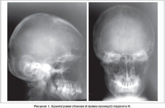 Вплив тріщини черепа: наслідки та відновлення після травми