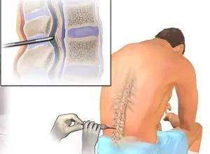 Спінальна анестезія: наслідки, про які варто знати кожному пацієнту