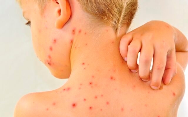 Чи можна митися при вітрянці дорослому: рекомендації та поради лікарів