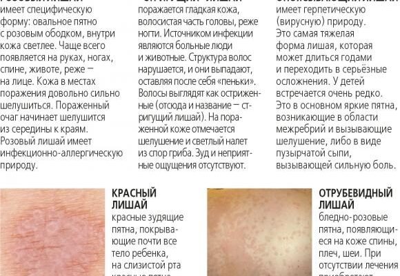 Чи можна мочити лишай: поради з догляду за шкірою при захворюванні