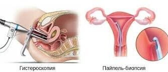 Пайпель біопсія ендометрію: наслідки та важливість процедури