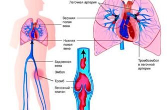 Чи можна спасти людину, якщо відірвався тромб: шанси на виживання