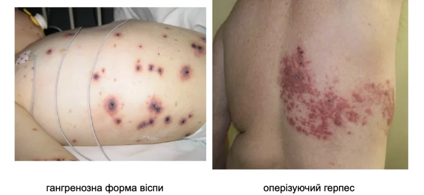 Наслідки вітрянки: як хвороба впливає на здоров’я дорослих і дітей