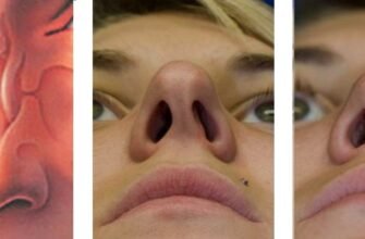 Крива перегородка носа: наслідки для здоров’я та як їх уникнути