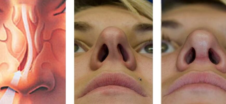 Крива перегородка носа: наслідки для здоров’я та як їх уникнути