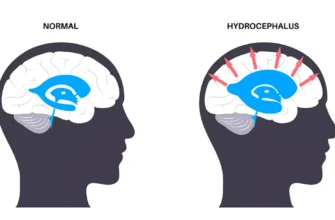 Гідроцефалія: наслідки, лікування та довгострокові перспективи життя