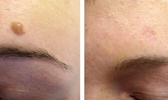 Чи можна видаляти родимки на обличчі: поради та застереження