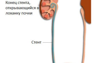Чи можна займатися коханням після стентування: що варто знати?