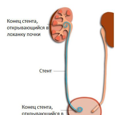Чи можна займатися коханням після стентування: що варто знати?