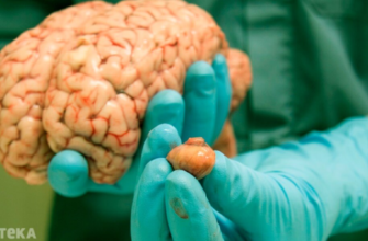 Чи можна вилікувати рак головного мозку: сучасні методи та перспективи