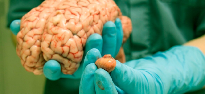 Чи можна вилікувати рак головного мозку: сучасні методи та перспективи