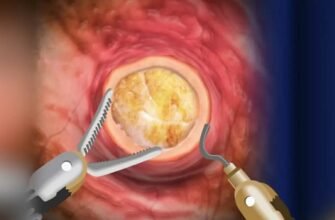 Наслідки після видалення міоми: як впливає операція на жіноче здоров’я