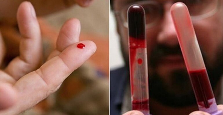 Густа кров: наслідки для здоров’я та як їх уникнути