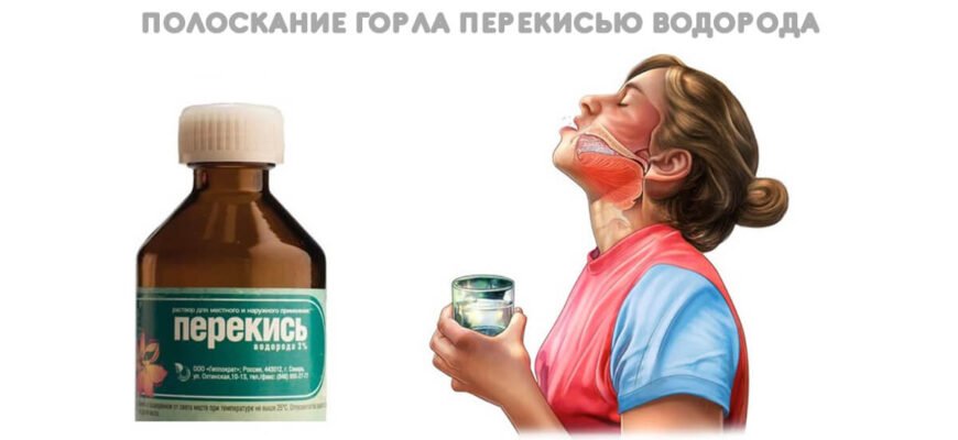 Чи можна полоскати горло перекисом водню: поради та застереження