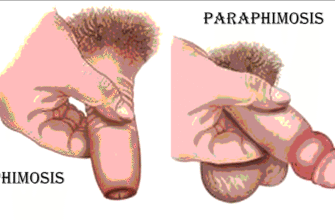 Чи можна жити з фімозом: поради та факти для чоловічого здоров’я