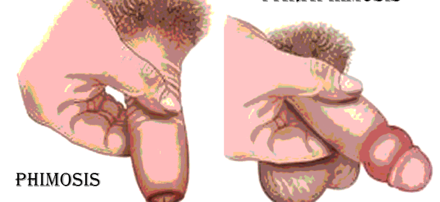 Чи можна жити з фімозом: поради та факти для чоловічого здоров’я
