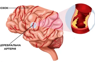 Наслідки цереброваскулярних хвороб: вплив на здоров’я та життя