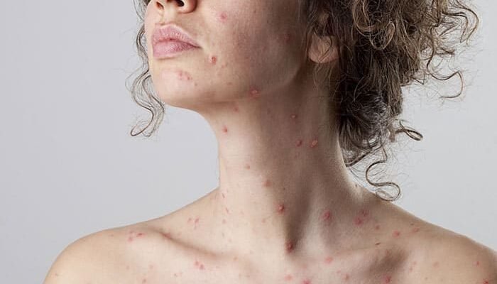 Наслідки вітрянки у дорослих: як уникнути ускладнень і ризиків