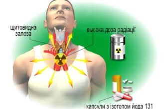 Наслідки після лікування радіоактивним йодом: що важливо знати