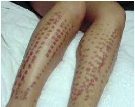 Наслідки лазерної епіляції: що потрібно знати перед процедурою