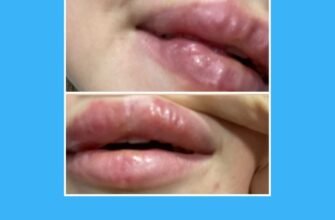 Збільшення губ: наслідки та ризики, про які варто знати