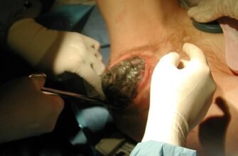 Епізіотомія: Наслідки процедури для здоров’я жінки після пологів