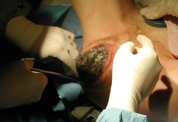 Епізіотомія: наслідки та їх вплив на відновлення після пологів