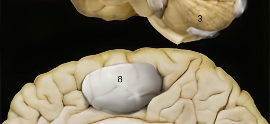 Кіста головного мозку: наслідки та вплив на здоров’я людини