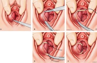 Наслідки видалення бартолінової залози: що чекає після операції?