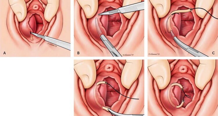 Потенційні наслідки видалення бартолінової залози: що варто знати?