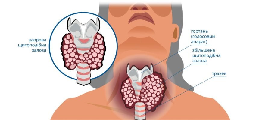Чи можна вилікувати аутоімунний тиреоїдит: нові методи та підходи