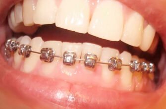 Чи можна ставити брекети на одну щелепу: що кажуть стоматологи?