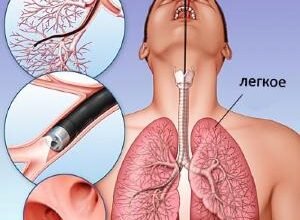 Наслідки бронхоскопії: що очікувати після процедури?