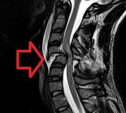 Наслідки травми хребта за МКХ-10: діагностика та лікування