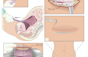 Кесарів розтин: наслідки та рекомендації для швидкого відновлення