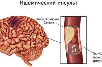 Інфаркт мозку: наслідки та відновлення після судинного інциденту