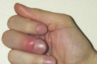 Чи можна парити нарив на пальці: безпека та рекомендації лікарів