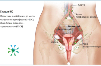 Віддалені наслідки променевої терапії малого тазу у жінок: аналіз та рекомендації