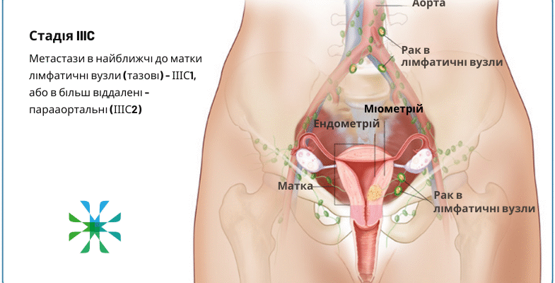 Віддалені наслідки променевої терапії малого тазу у жінок: огляд проблем