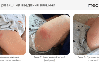 Вплив КПК-вакцини: Наслідки для здоров’я та суспільства