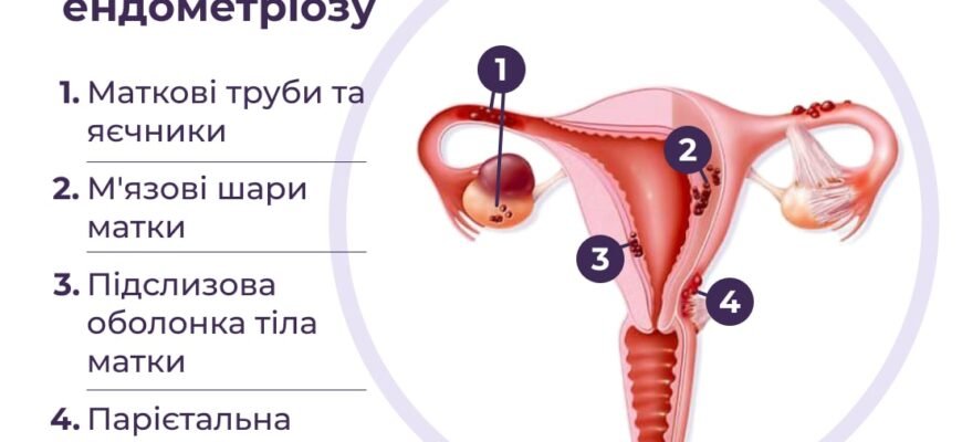 Чи можна завагітніти при ендометріозі: реалії та поради фахівців
